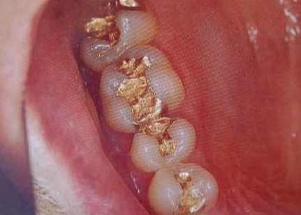 Gold-Inlay
